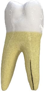 Vertical root fracture diagram