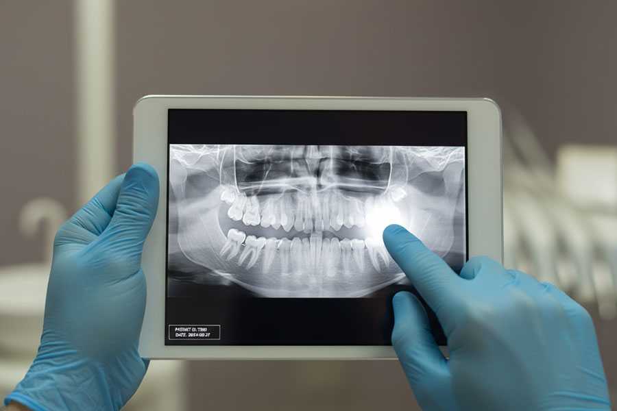 Digital radiography equipment for low-radiation dental x-rays