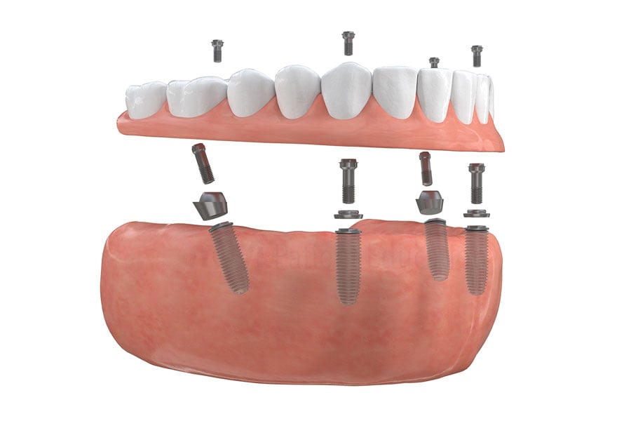 Full-arch implant-supported bridge at Dr. Raffi General & Implant Dentistry