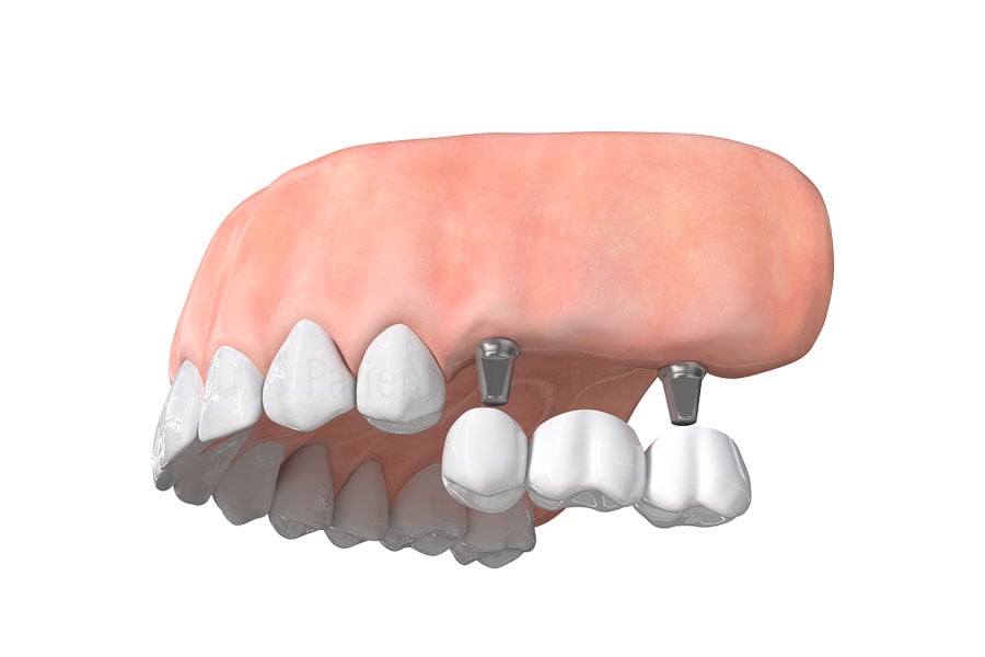 Implant-supported dental bridge at Dr. Raffi General & Implant Dentistry
