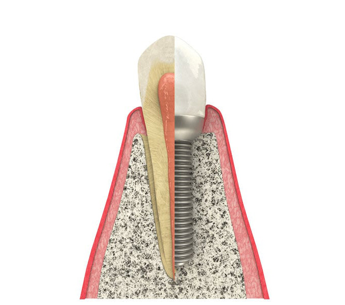 Dental implant model showing titanium post, abutment, and crown