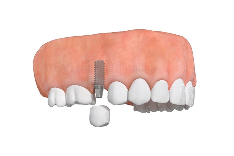 Dental implant compared to traditional denture