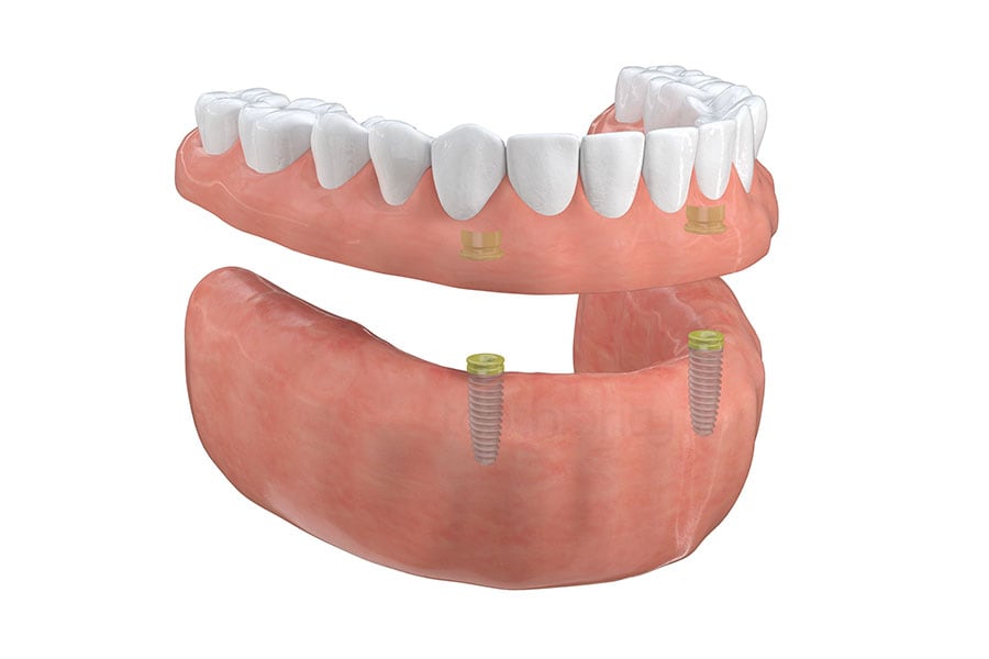 Implant-supported overdenture at Dr. Raffi General & Implant Dentistry