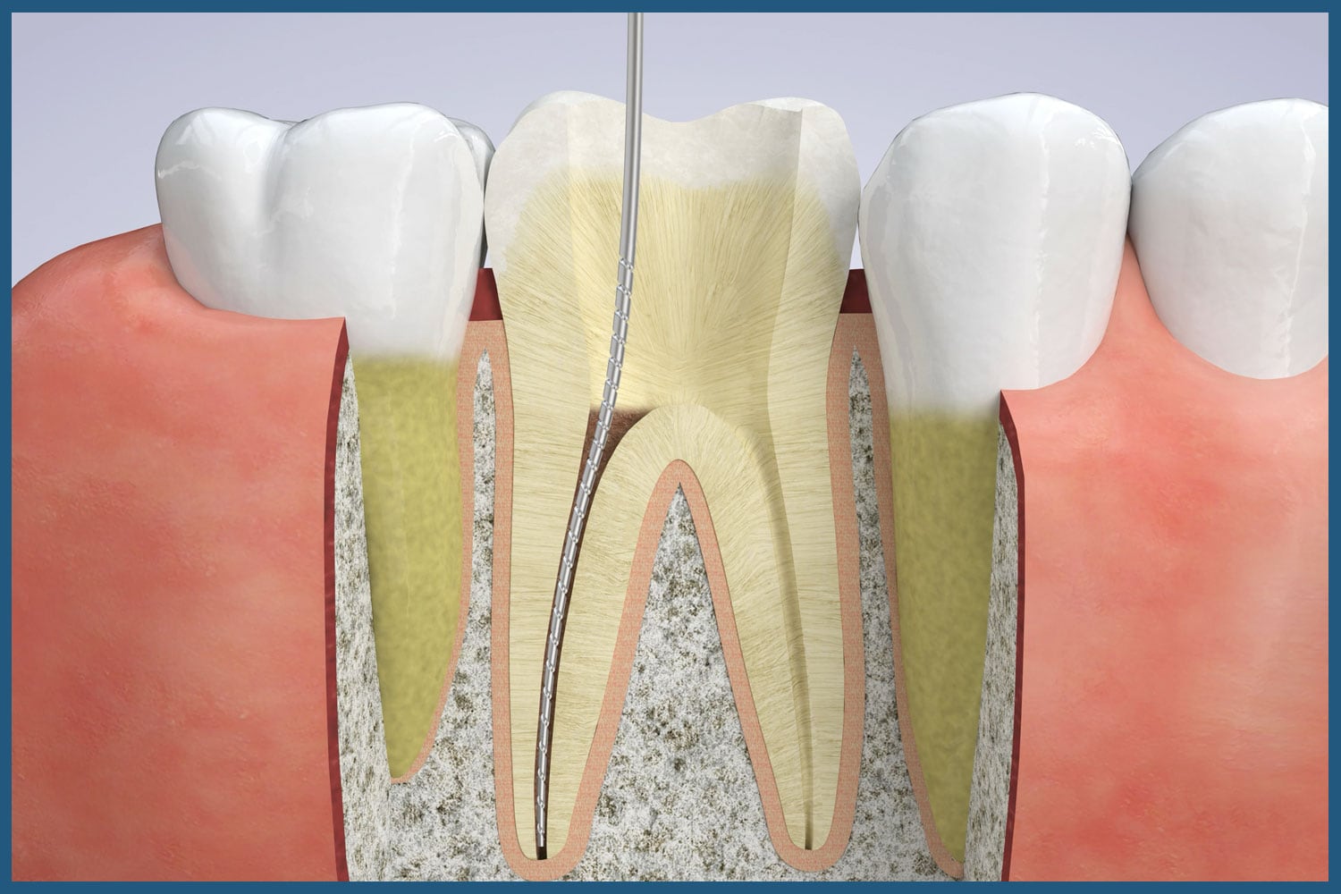 Stages of root canal therapy at Dr. Raffi General & Implant Dentistry