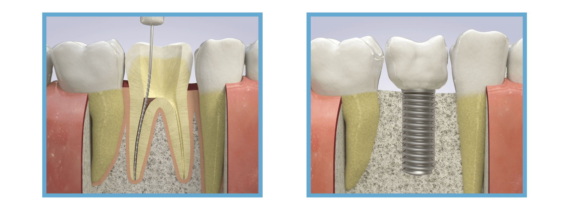 Visual comparison of root canal therapy versus dental implant