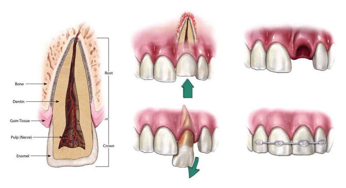 Dental trauma treatment at Dr. Raffi General & Implant Dentistry in Chicago, IL
