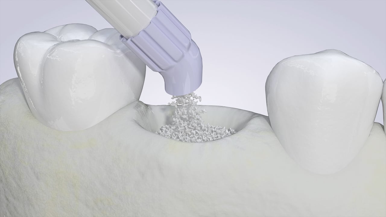 Poster image for the Bone Grafting patient-education video