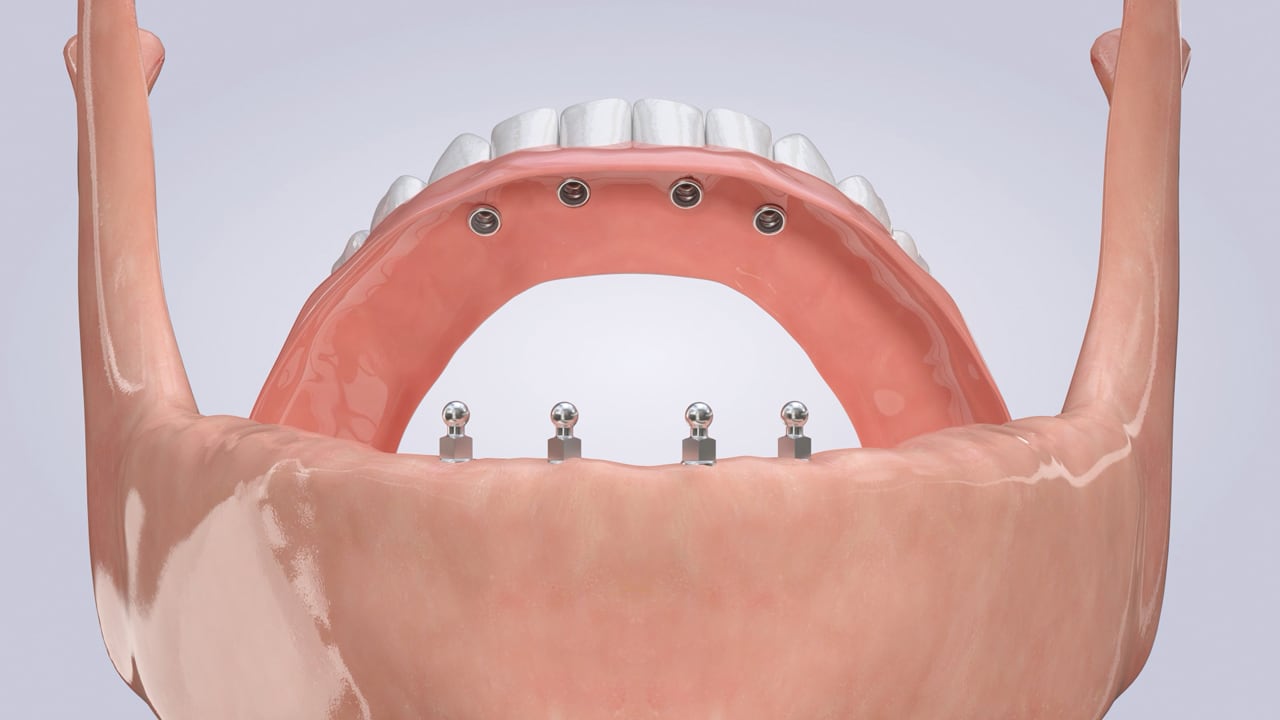 Poster image for the Denture Stabilization patient-education video