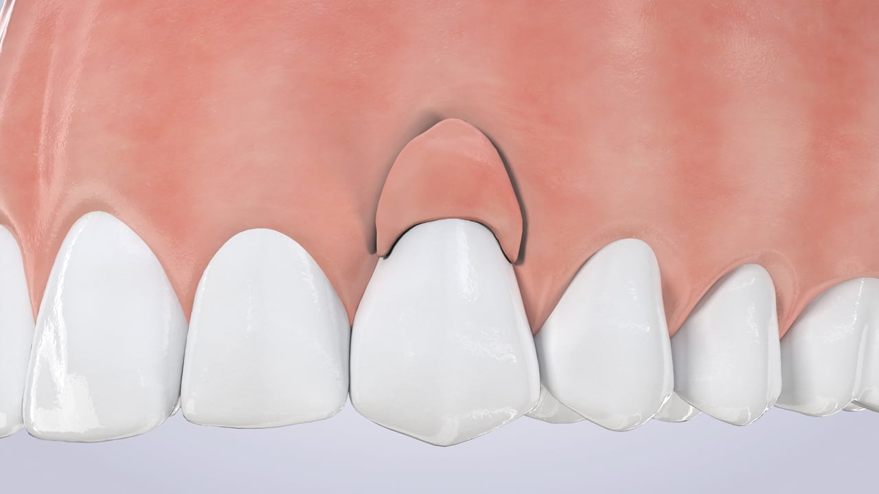 Poster image for the Gum Recession patient-education video
