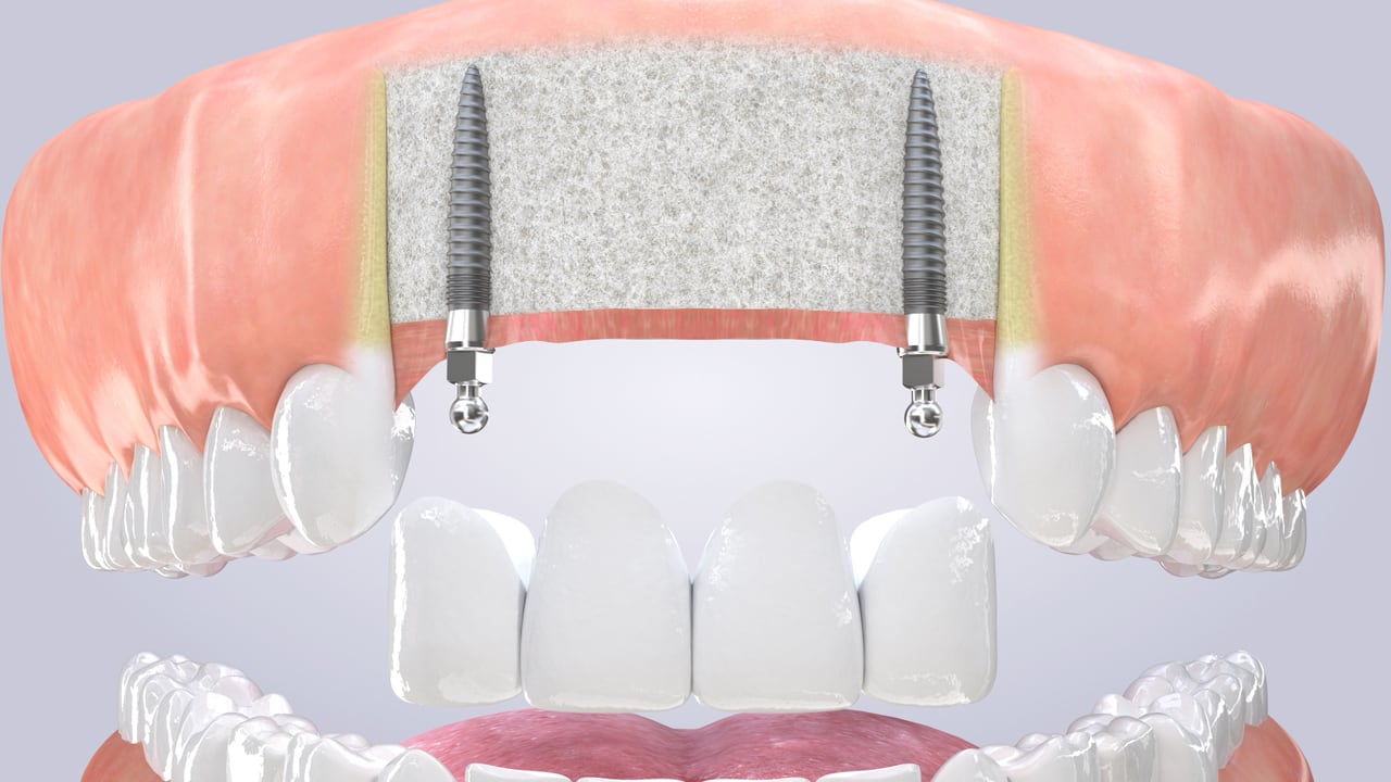Poster image for the Multiple Teeth with Mini Implants patient-education video