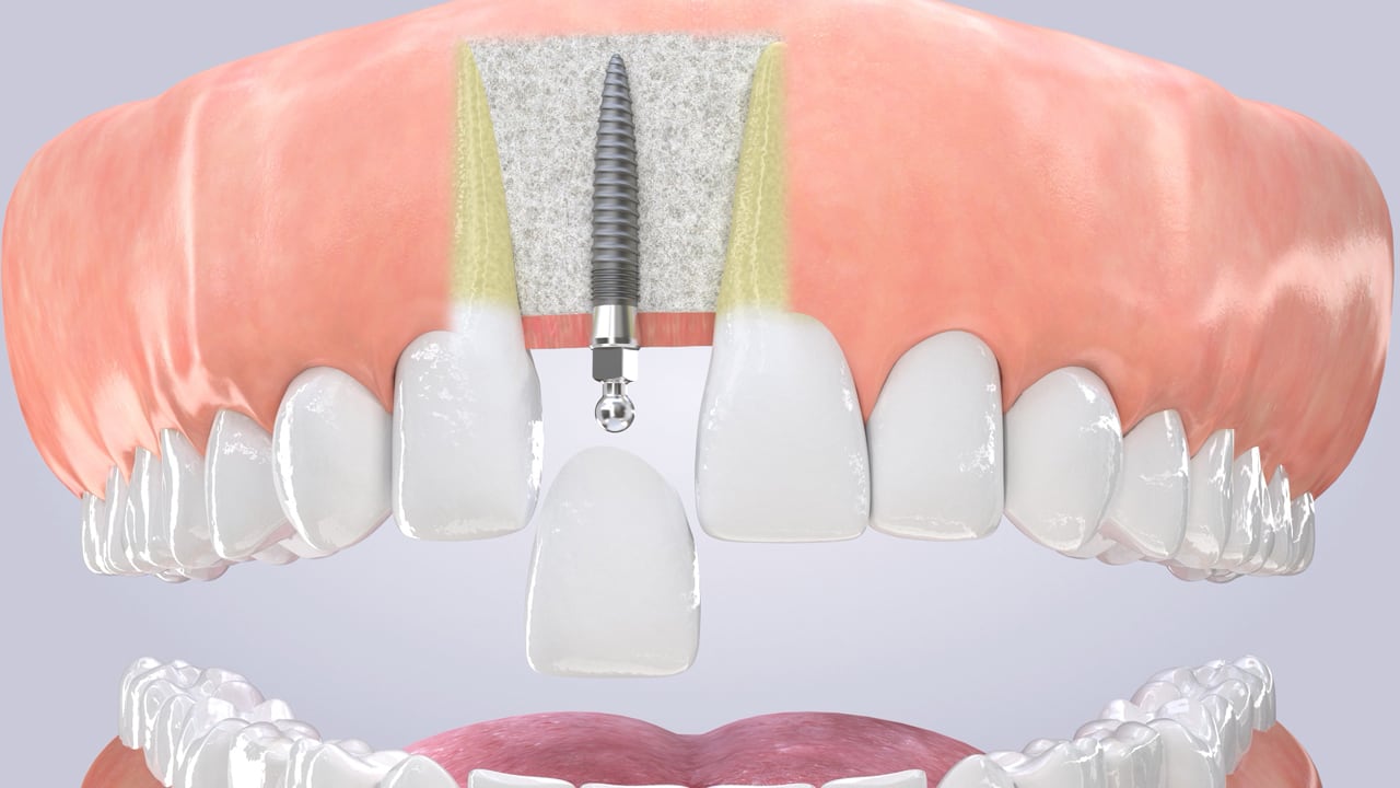 Poster image for the Single Tooth with Mini Implant patient-education video