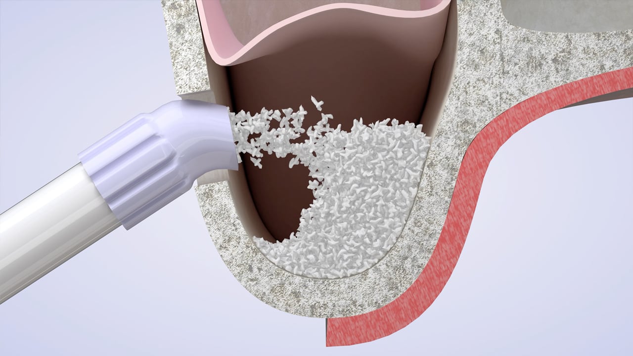 Poster image for the Sinus Augmentation patient-education video